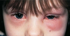 なぜ鼻づまりや副鼻腔炎が目の下のくま・目の周りの腫れの原因となるのか