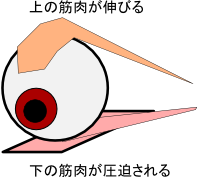 眼瞼下垂などによる筋力の圧迫
